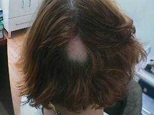 MED_imagenes_imagen_alopecia-areata-femenina265_072